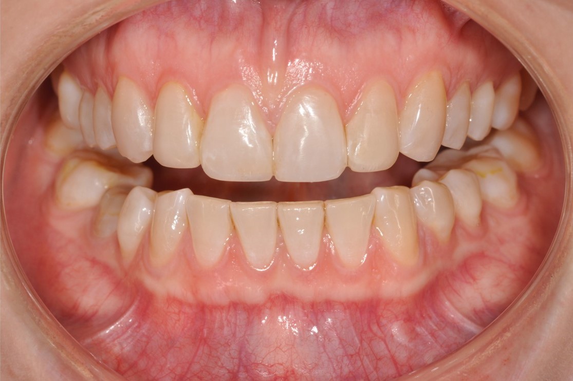 Cosmetic Bonding Halifax, NS Dr. Jenine Arab Omalley